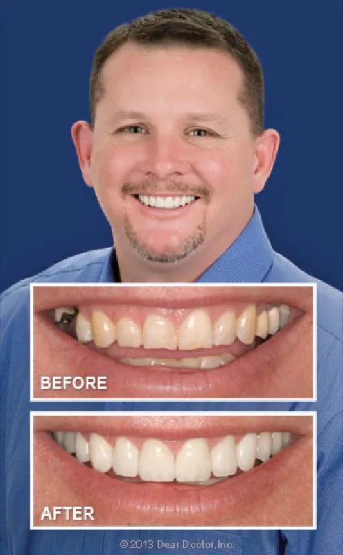 Smile makeover before and after